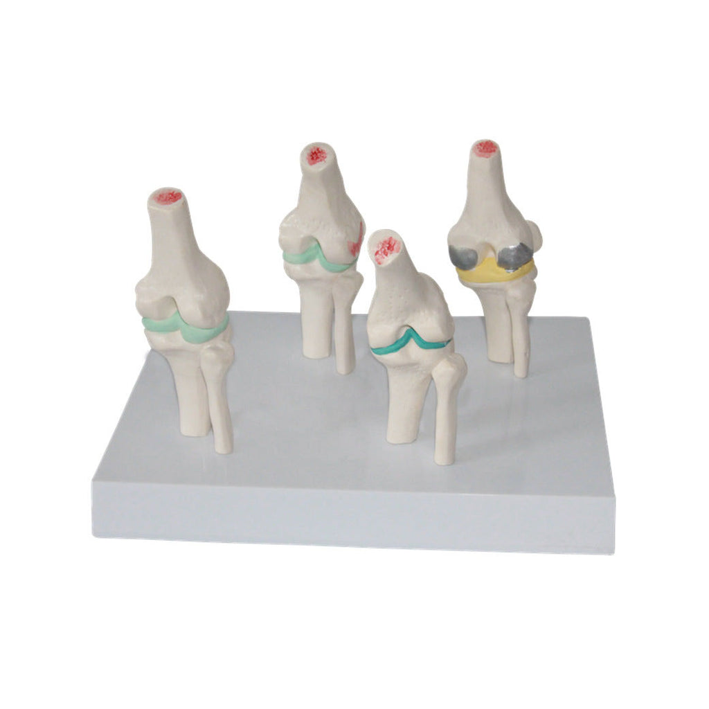Knee Joints Set, 1/2 Life-Size - Dr Wong Anatomy
