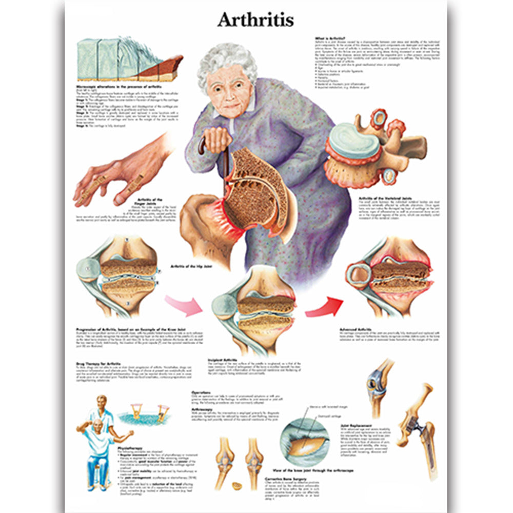 Arthritis Chart - Dr Wong Anatomy