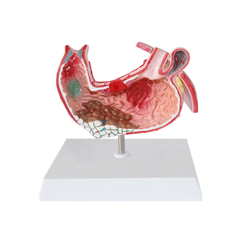  Gastric Diseases Model, Life-Size - Dr Wong Anatomy