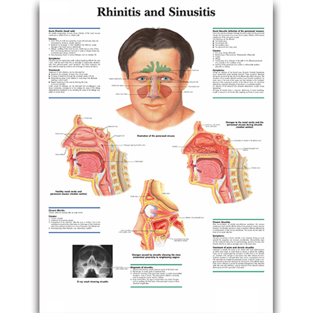 Rhinitis and Sinusitis Chart - Dr Wong Anatomy