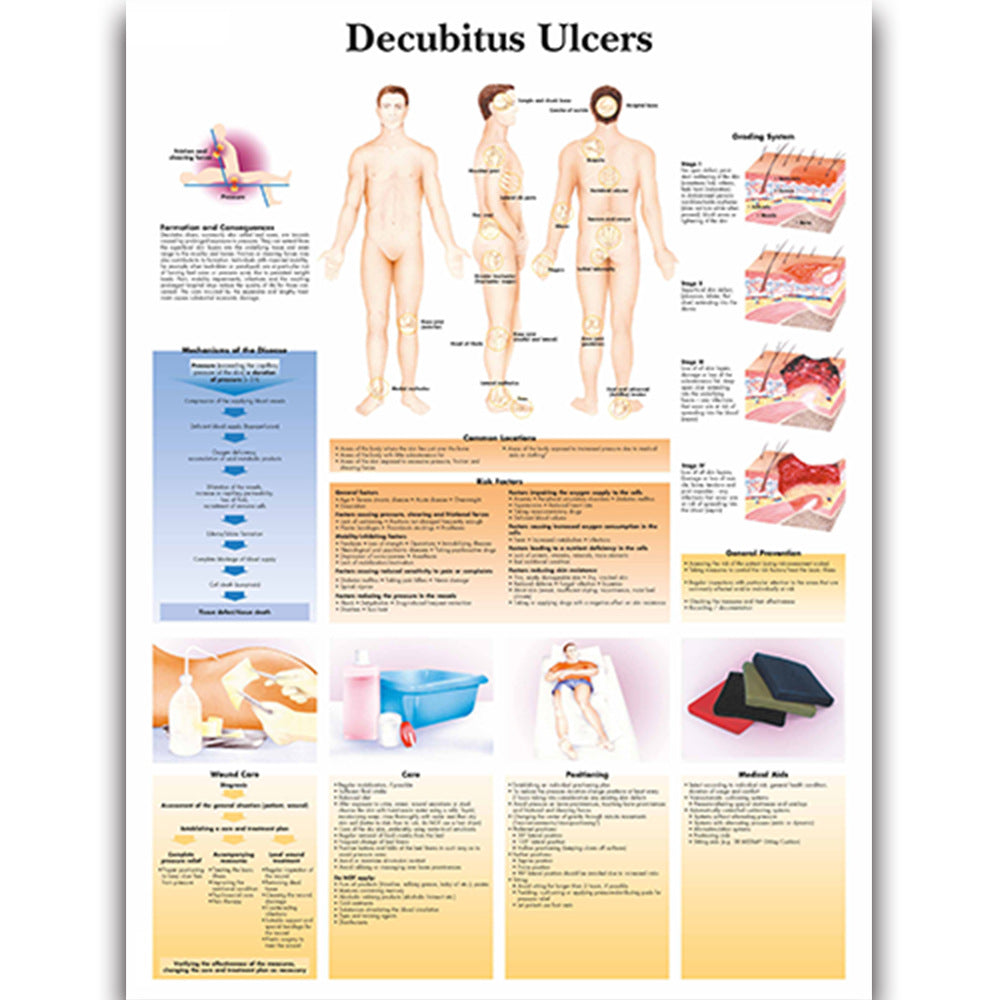 Decubitus Ulcers disease Chart - Dr Wong Anatomy