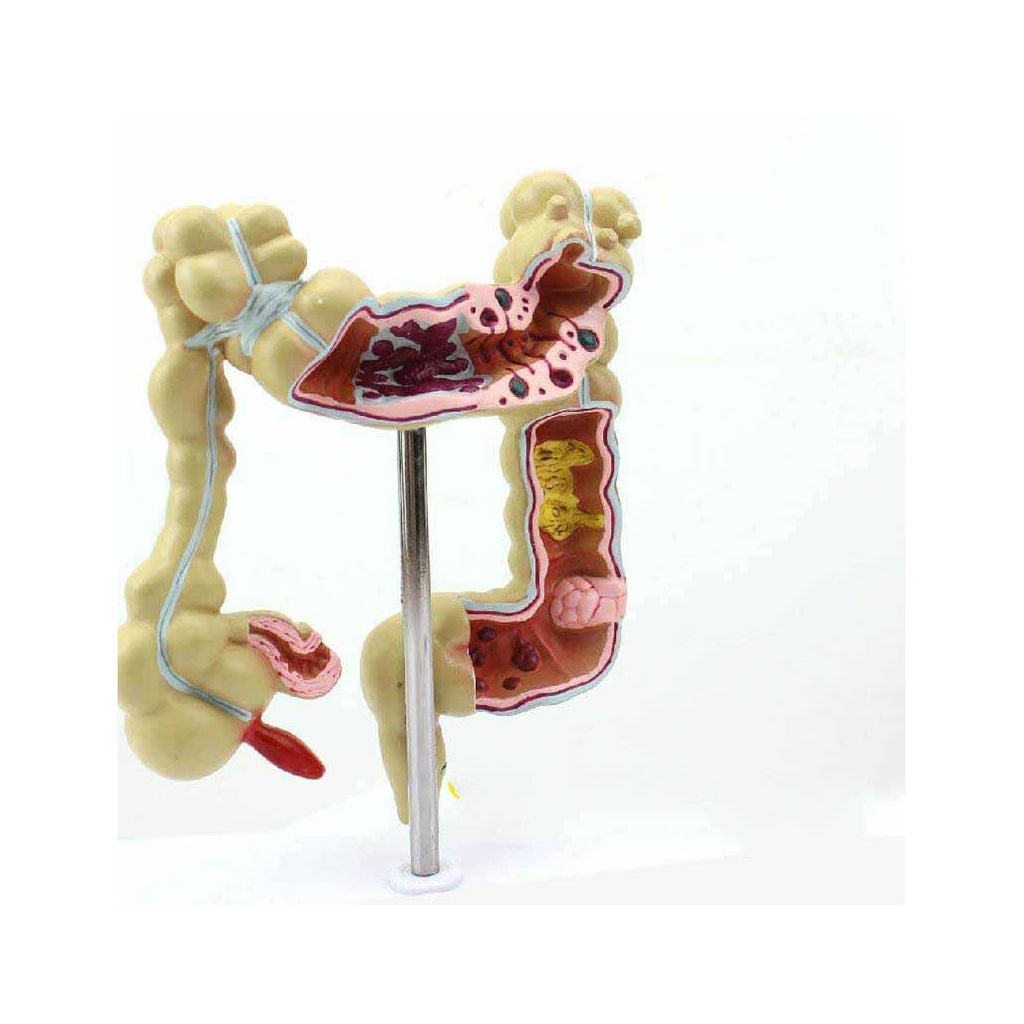 Colon Model with Pathologies - Dr Wong Anatomy