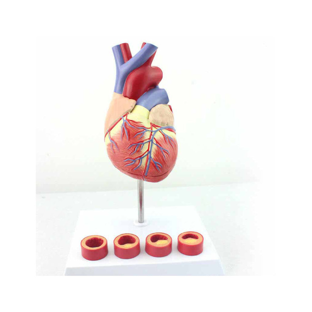 Heart Model With Artery And Heart Disease Display - Dr Wong Anatomy
