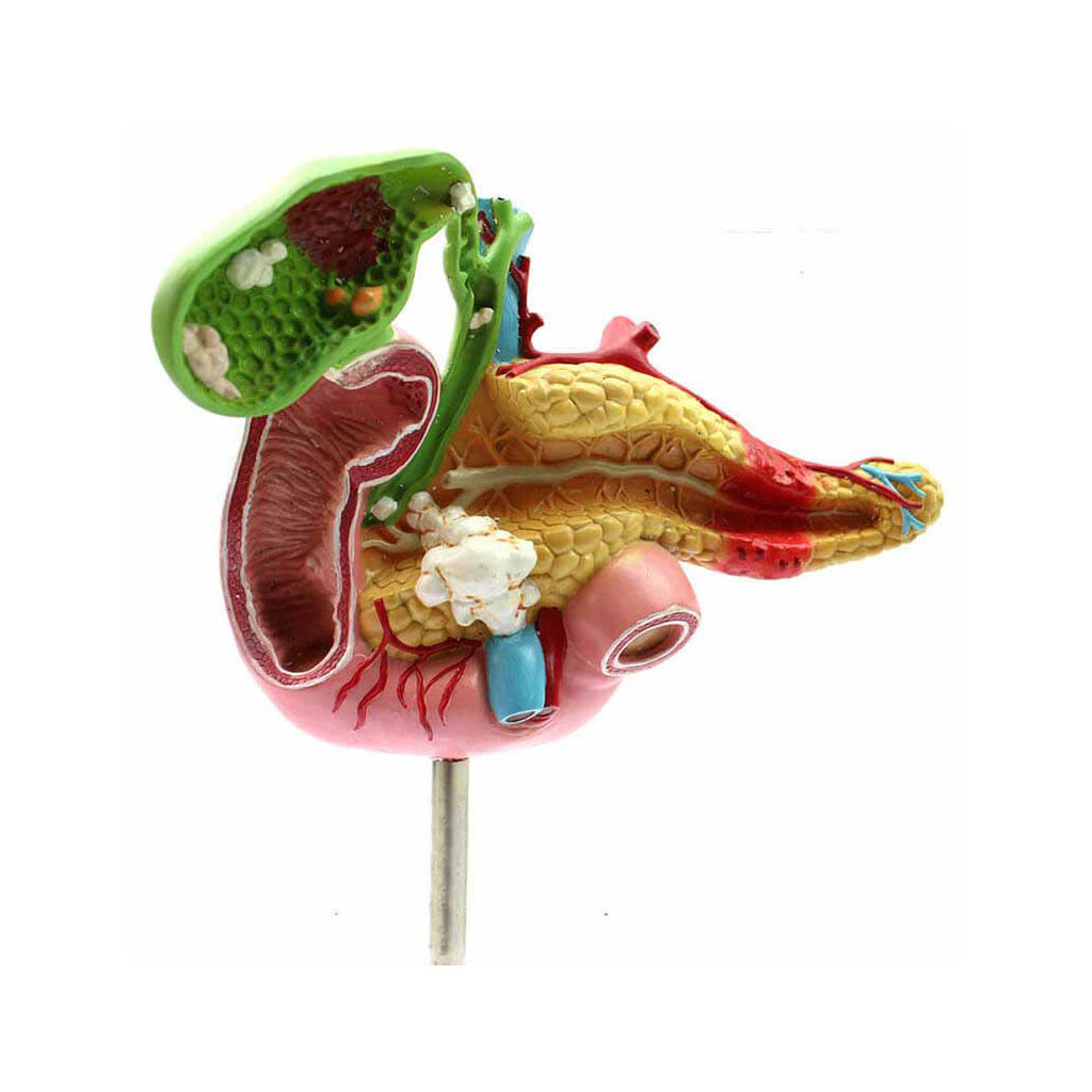 Pathological Model Of Pancreas，Duodenum ,Gallbladder - Dr Wong Anatomy