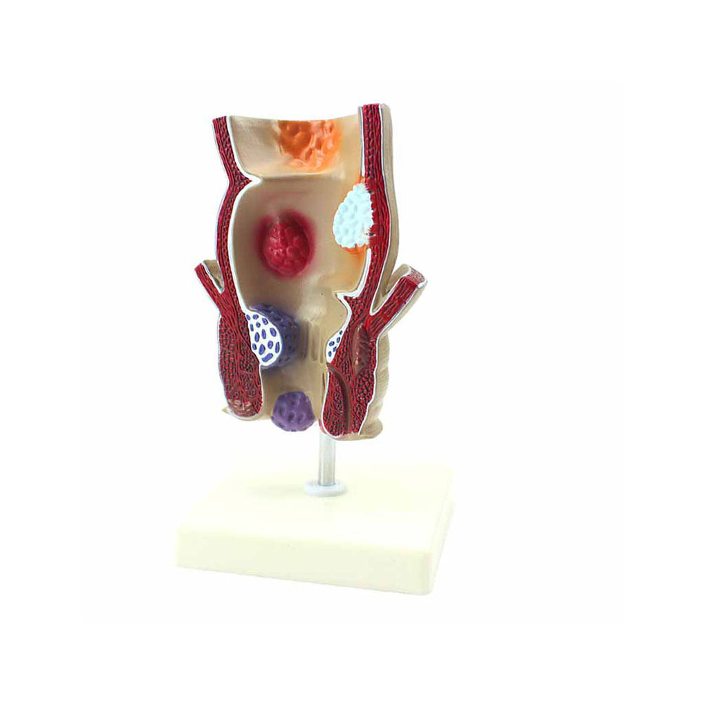 Pathological Model Of The Rectum，1.5X Life-Size - Dr Wong Anatomy