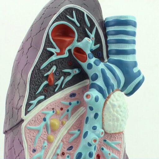 Pathological Model of the Lung – Dr Wong Anatomy