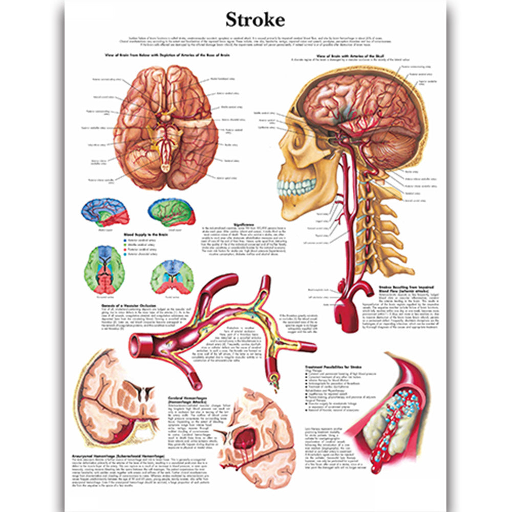 Stroke Chart - Dr Wong Anatomy