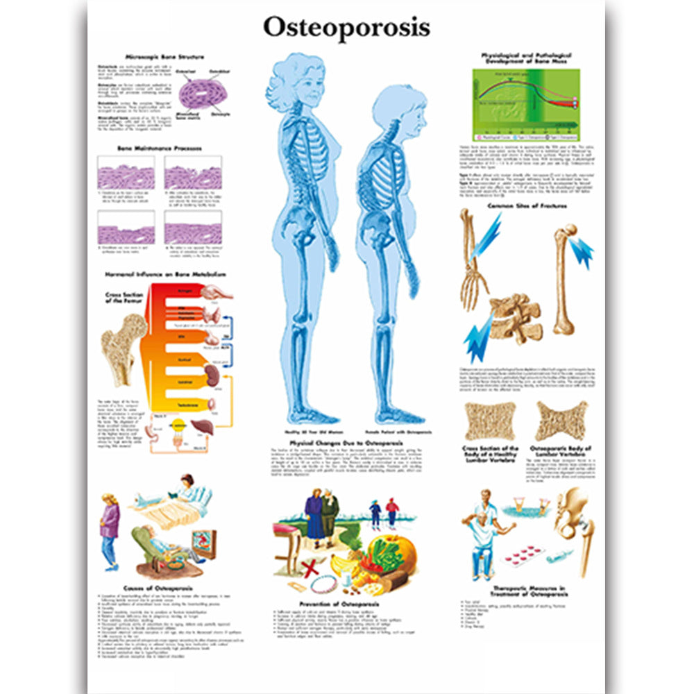 Health Education Chart Osteoporosis