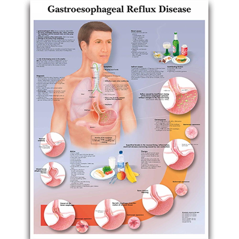  Gastroesophageal Reflux Disease Chart - Dr Wong Anatomy