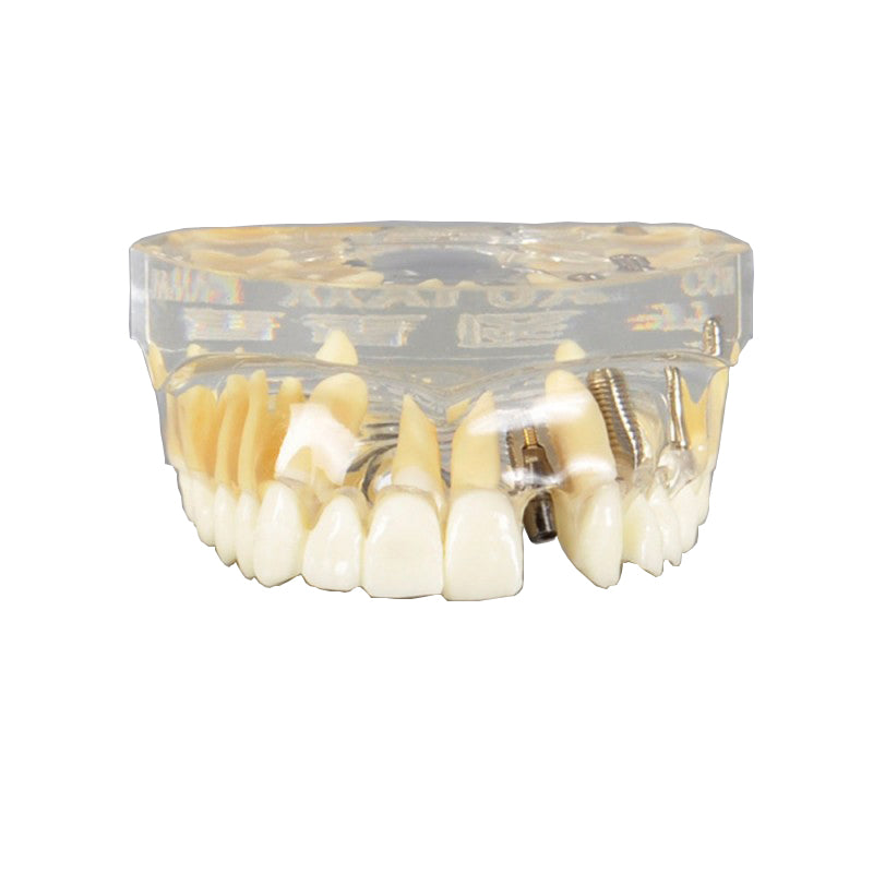 Dental Implant Model with Crown and Bridge