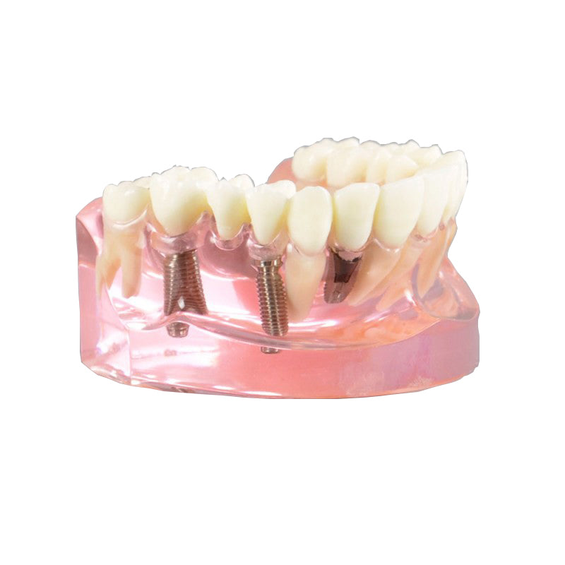 Dental Implant Model with Ceramic Bridge Implant Bridge