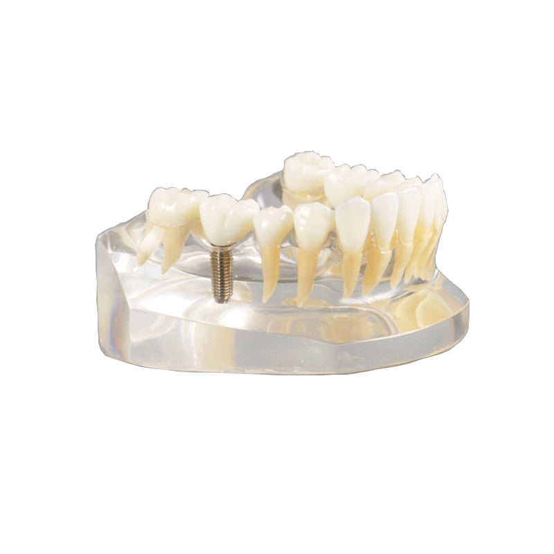  Dental Implant Model Mandibular with Natural Color Teeth