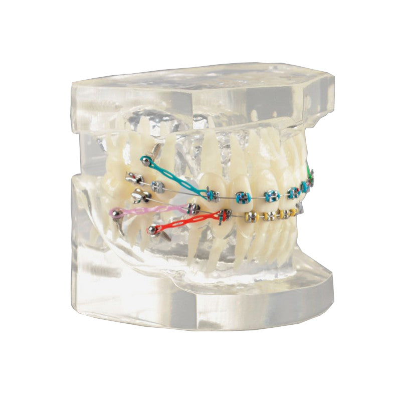 Dental Orthodontic Model with Bracket and Ligature Wire Affixed