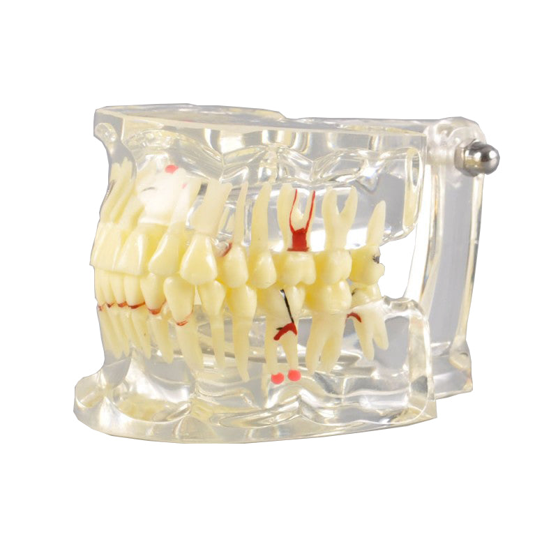 Adult Dental Pathological Model-Missing Tooth