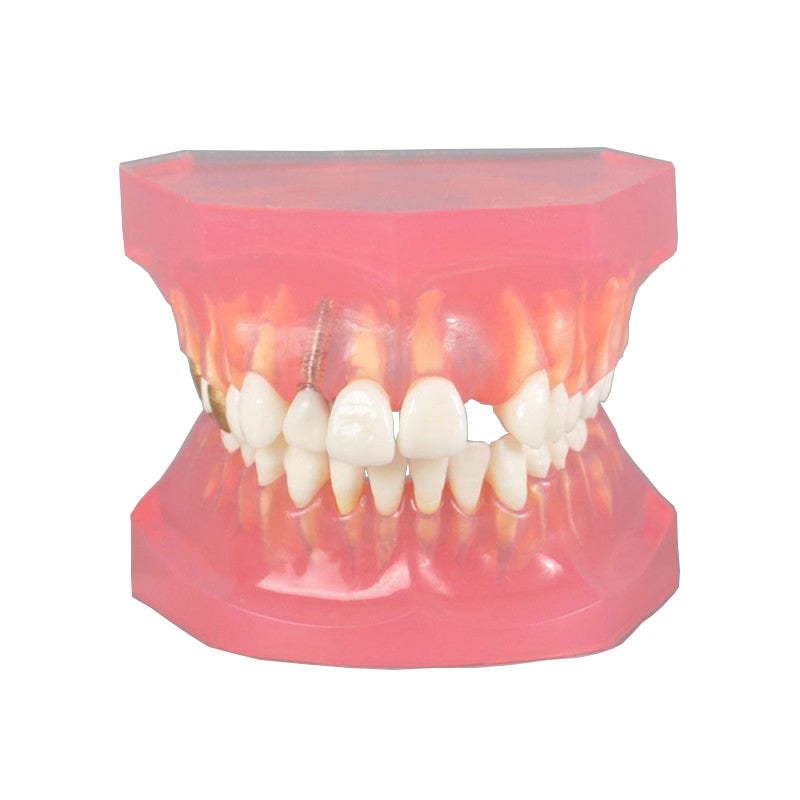 Dental Model with Caries Treatment and Other Cases