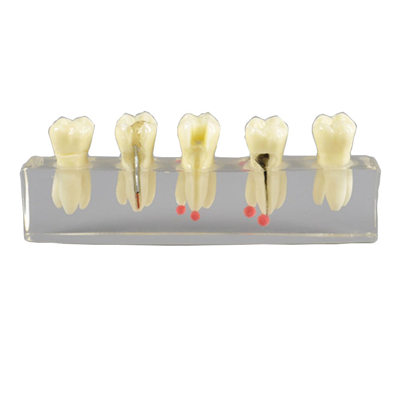 Dental Root Canal Model with Restoration