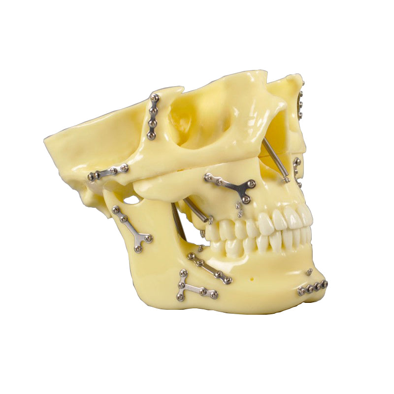 Skull Model with Fracture and Orthodontic Implant