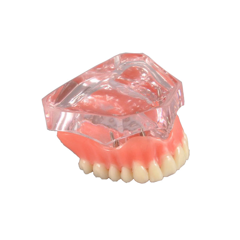 Dental Overdenture Model with Implants