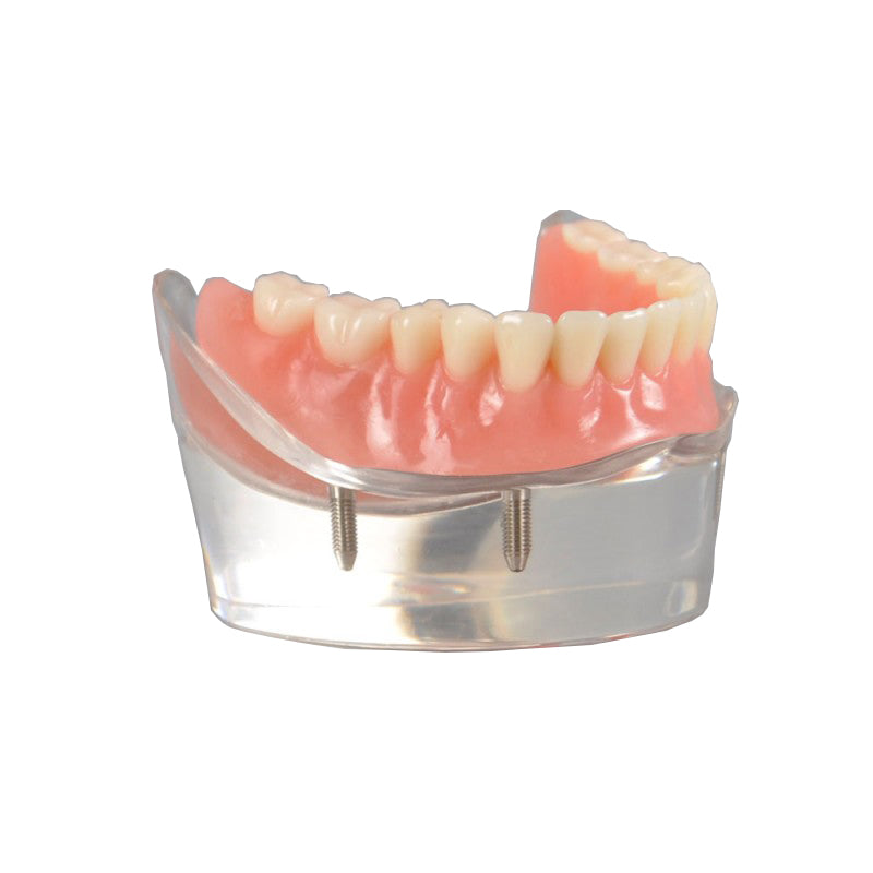 Dental Overdenture Model with 4 Implants