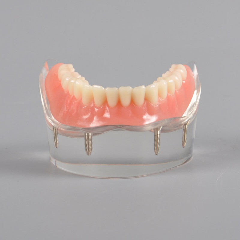 Modèle Dentaire D'arcade Supérieure/inférieure Avec 4 Implants Et Bridge - Neuf Pour Laboratoire