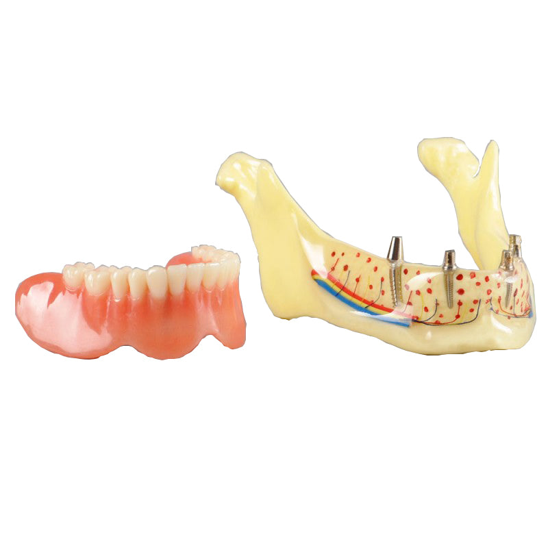 Dental Overdenture Jaw with Implant