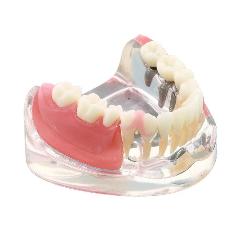 Dental Implant Model with Restoration