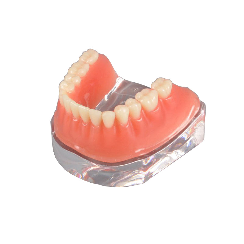 Dentarl Implant Model with Golden Bar