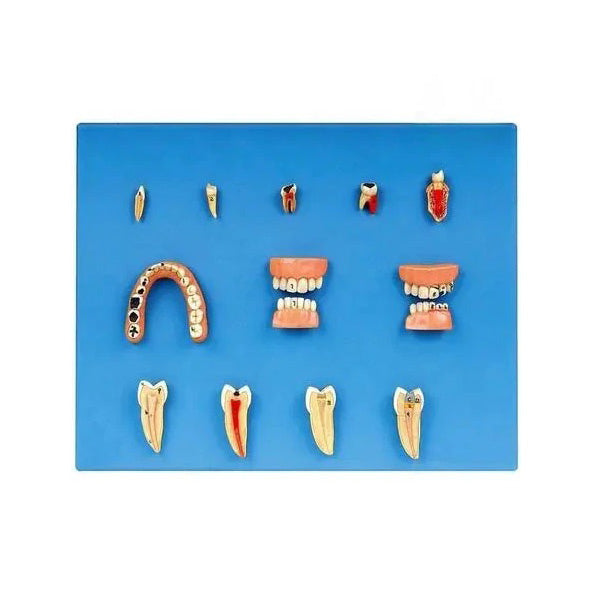 Dental Disease Model
