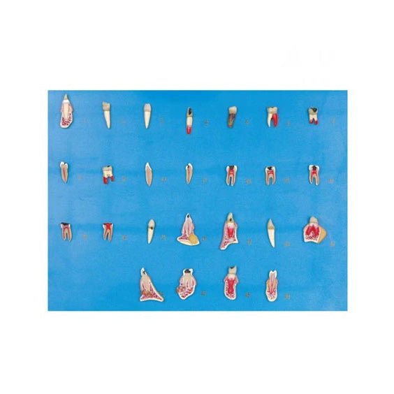 Dental Disease Model