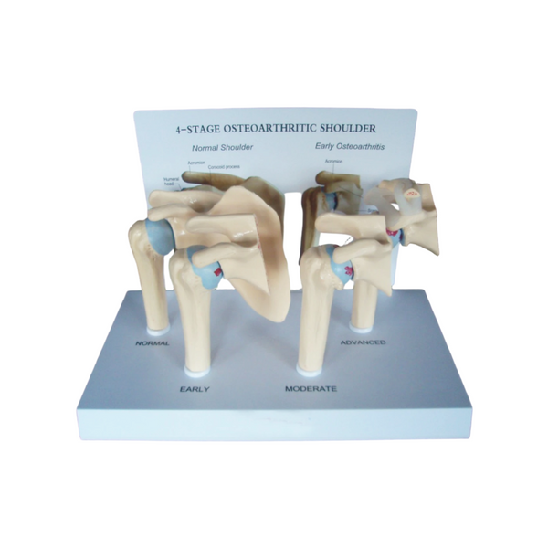 4-Stage Osteoarthritis Shoulder Anatomy Model