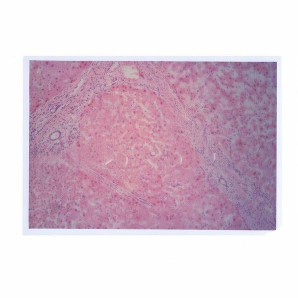 Liver Cirrhosis, Microscope Slide - Dr Wong Anatomy