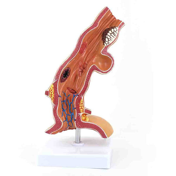 Esophagus Diseases Model
