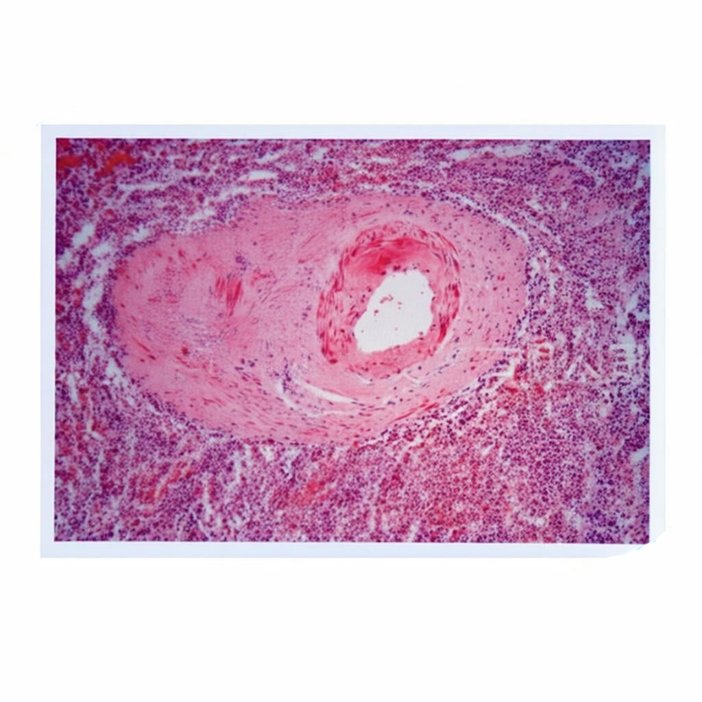 Spleen Small Artery Hyaline Degeneration, Microscope Slide - Dr Wong Anatomy