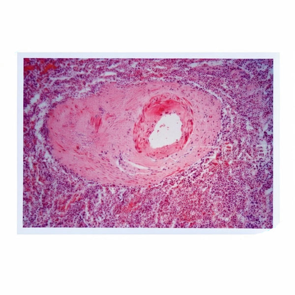 Spleen Small Artery Hyaline Degeneration, Microscope Slide - Dr Wong Anatomy