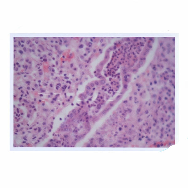 Acute Pyelonephritis, Microscope Slide - Dr Wong Anatomy