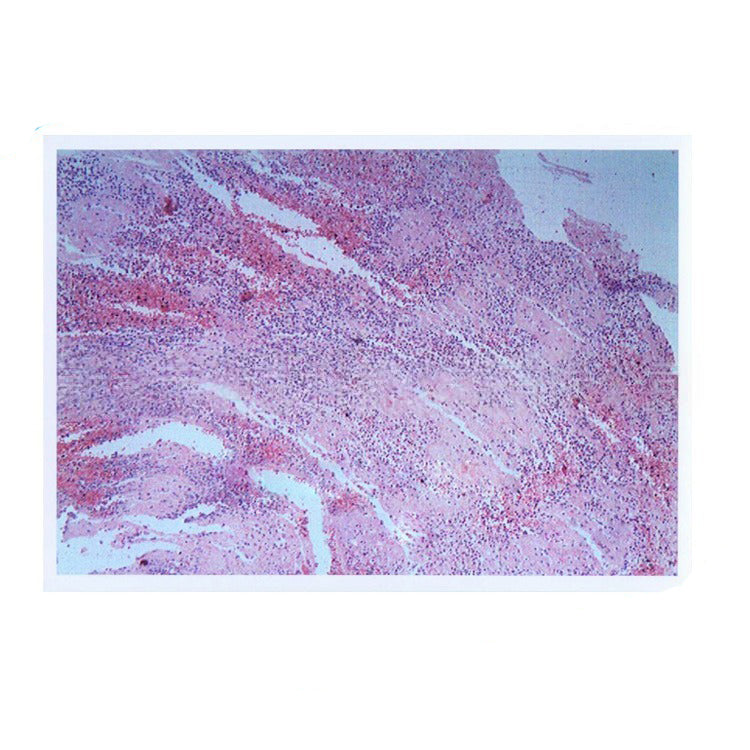 Mixed Thrombus, Microscope Slide - Dr Wong Anatomy