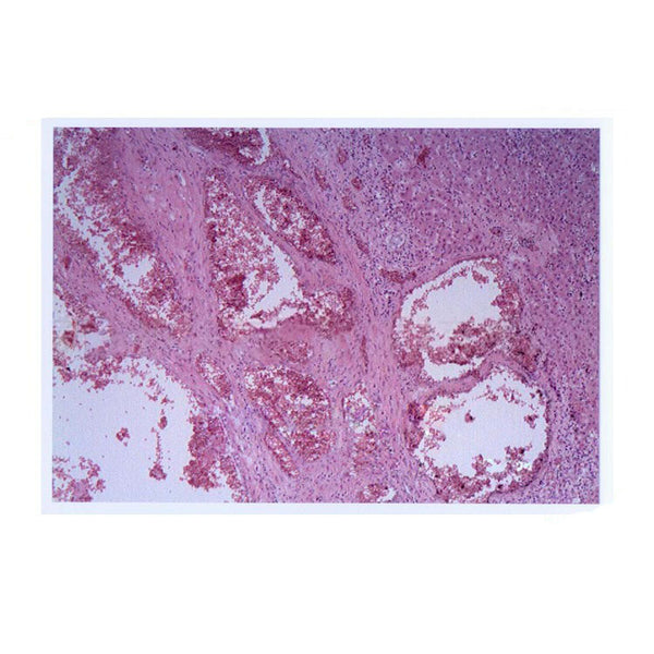 Human Hemangioma, Microscope Slide - Dr Wong Anatomy