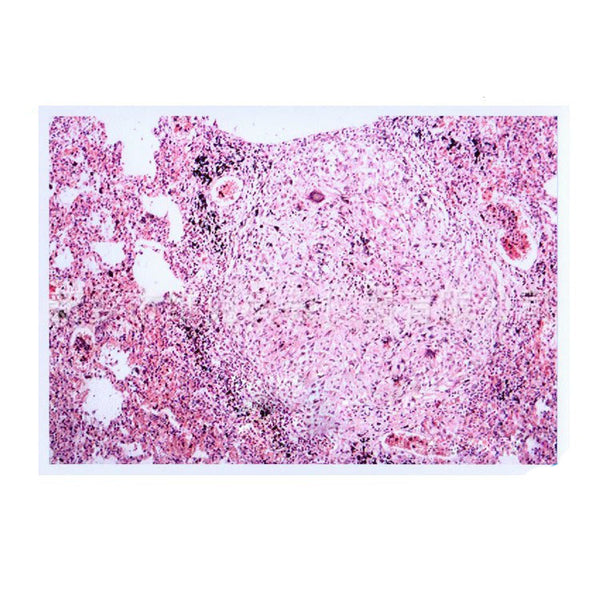 Human Pulmonary Tuberculosis, Microscope Slide - Dr Wong Anatomy