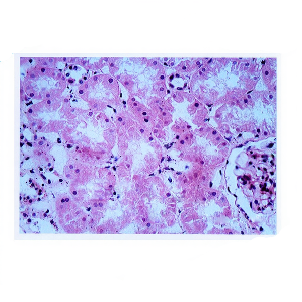 Renal Tubular Epithelial Cell Swelling, Microscope Slide - Dr Wong Anatomy