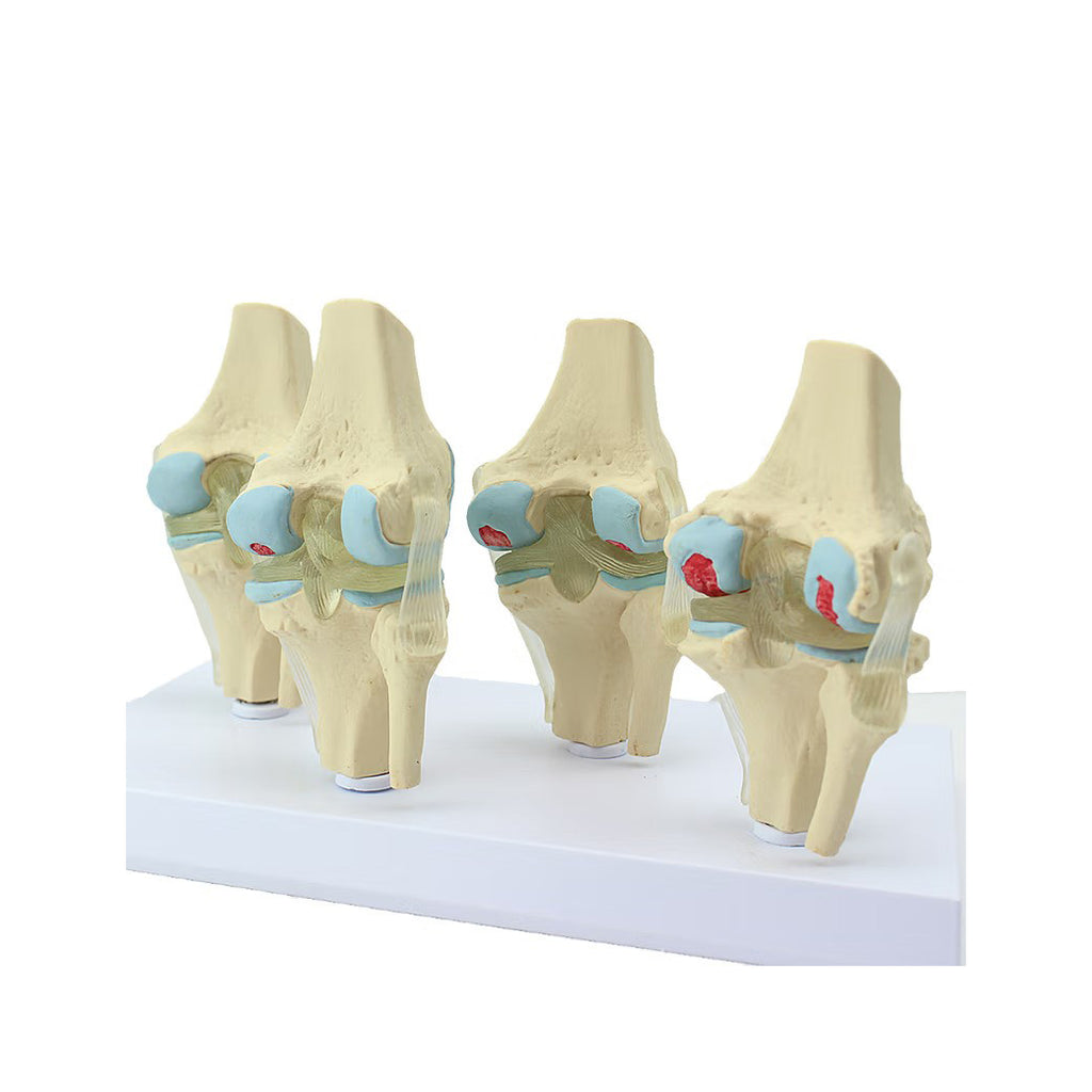 Degenerative Knee Joint Disease Model