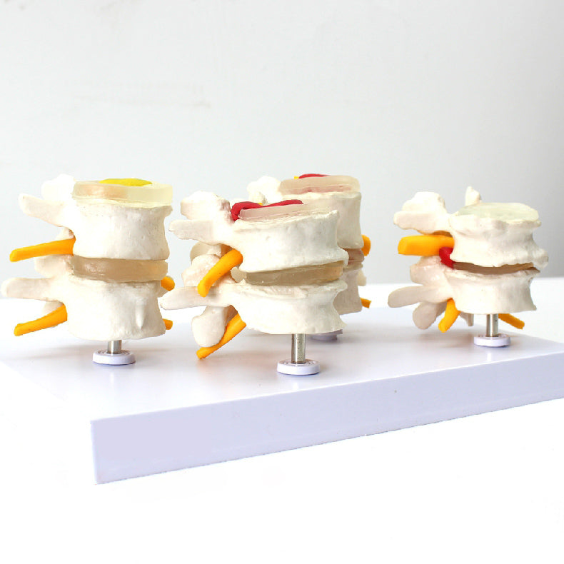 Degenerative Lumbar Vertebrae Disk Disease