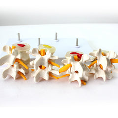 Degenerative Lumbar Vertebrae Disk Disease