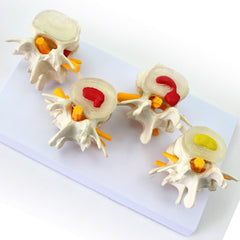 Degenerative Lumbar Vertebrae Disk Disease