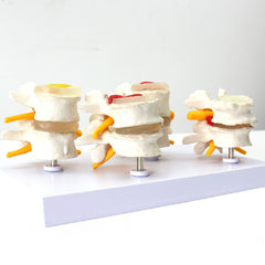 Degenerative Lumbar Vertebrae Disk Disease