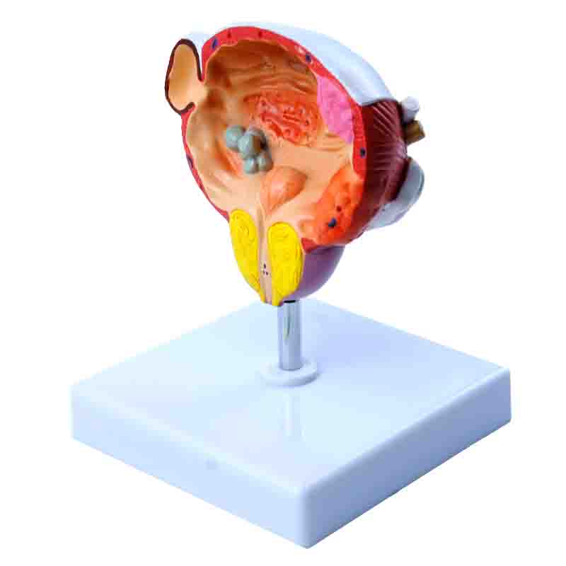 Prostate Scale Model Diseases of Bladder and Prostate Model – Dr Wong Anatomy