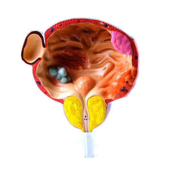 Diseases of Bladder and Prostate Model