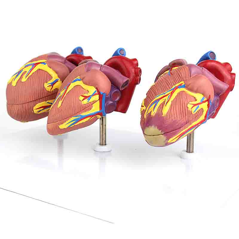 Heart Disease Model Set – Dr Wong Anatomy