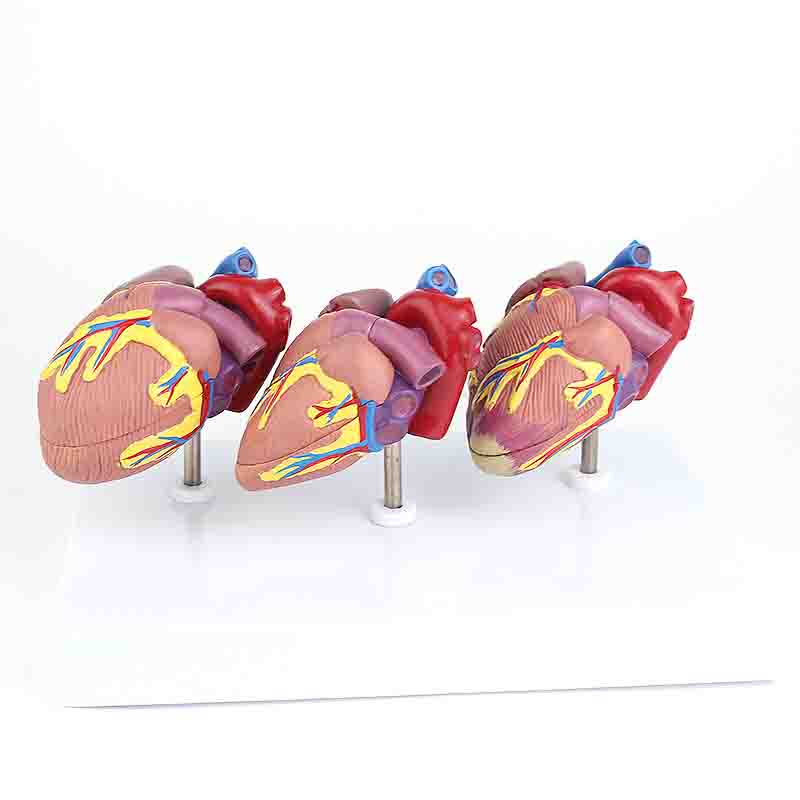Heart Disease Model Set – Dr Wong Anatomy