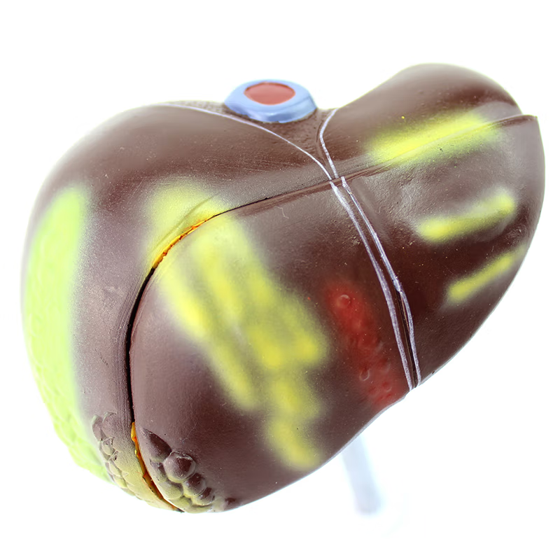 Liver Diseases Model，1/3 Life-Size, 2 Parts – Dr Wong Anatomy
