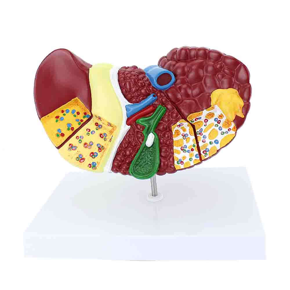 Liver with Pathologies Model
